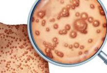 Photo of Pakistan Reports 1st Case of Monkeypox Virus