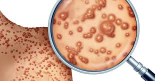 Photo of Pakistan Reports 1st Case of Monkeypox Virus