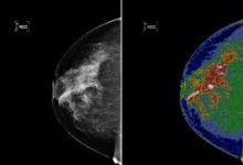 Photo of Breast Density Alerts Causing Confusion Among Women