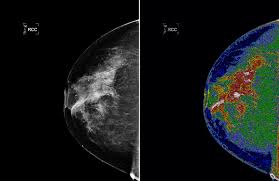 Photo of Breast Density Alerts Causing Confusion Among Women